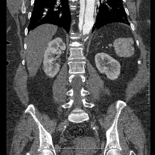 Aortic dissection- Stanford A (Radiopaedia 35729-37268 F 13).jpg