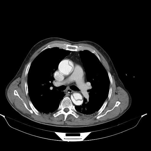 Aortic dissection- Stanford type A (Radiopaedia 22085-22085 A 20).jpg