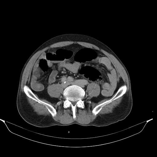 File:Aortic dissection- Stanford type A (Radiopaedia 22085-22085 Axial C+ delayed 35).jpg