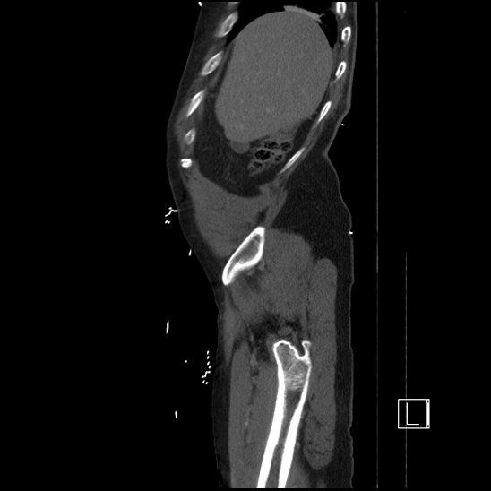 Aortic dissection (CTPA) (Radiopaedia 75506-86750 G 12).jpg