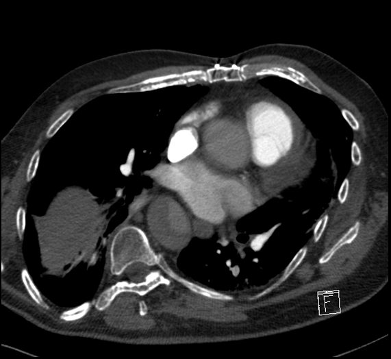 File:Aortic dissection (CTPA) (Radiopaedia 75506-86751 Axial C+ CTPA 78).jpg
