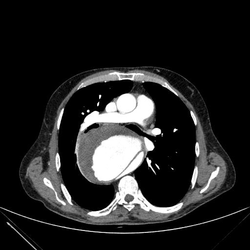 Aortic dissection (Radiopaedia 27466-27665 C+ arterial phase 114).jpg