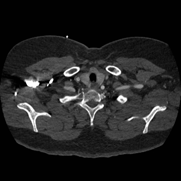 Aortic dissection (Radiopaedia 57969-64959 A 31).jpg
