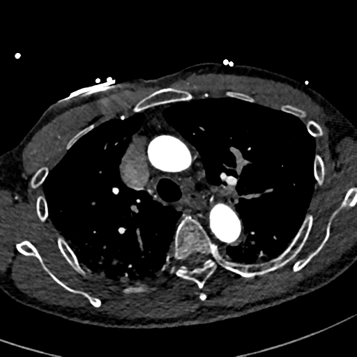 File:Aortic dissection - DeBakey type II (Radiopaedia 64302-73082 A 29).png