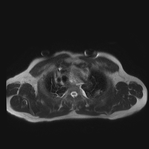 File:Aortic dissection - Stanford A -DeBakey I (Radiopaedia 28339-28586 Axial T2 3).jpg