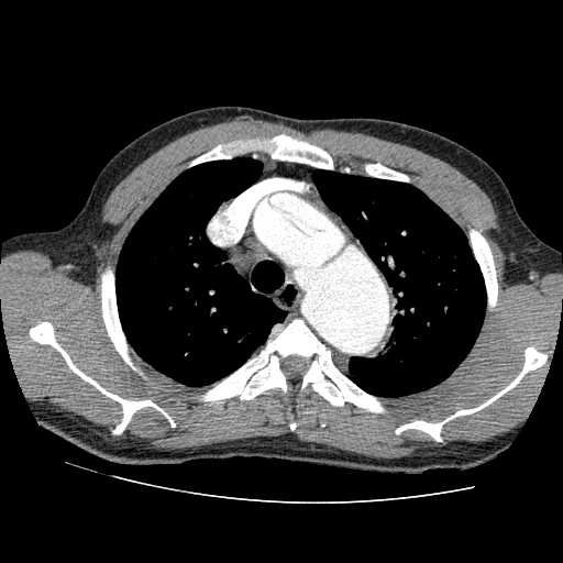 File:Aortic dissection - Stanford A -DeBakey I (Radiopaedia 28339-28587 B 10).jpg