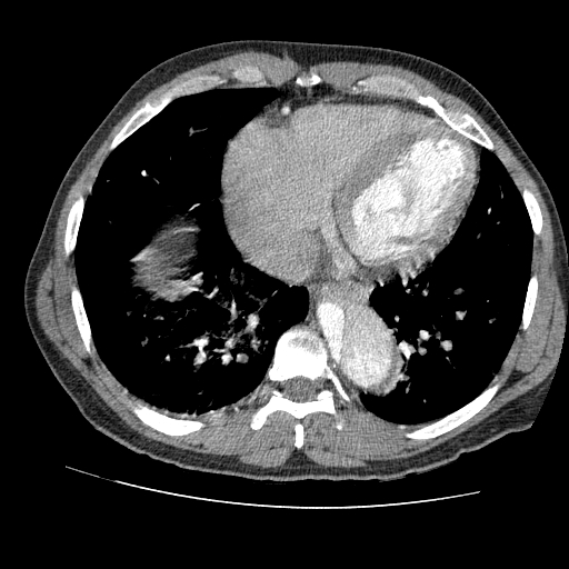 File:Aortic dissection - Stanford A -DeBakey I (Radiopaedia 28339-28587 B 72).jpg