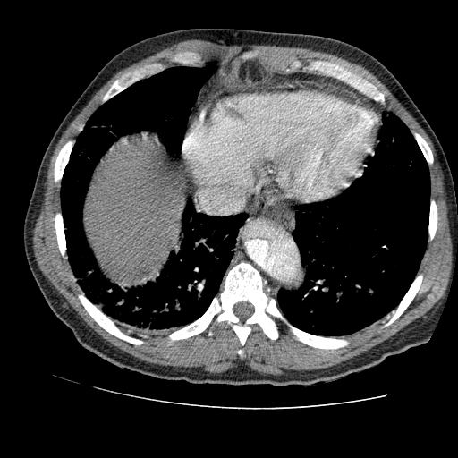File:Aortic dissection - Stanford A -DeBakey I (Radiopaedia 28339-28587 B 78).jpg