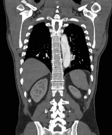 File:Aortic dissection - Stanford type B (Radiopaedia 73648-84437 B 90).jpg