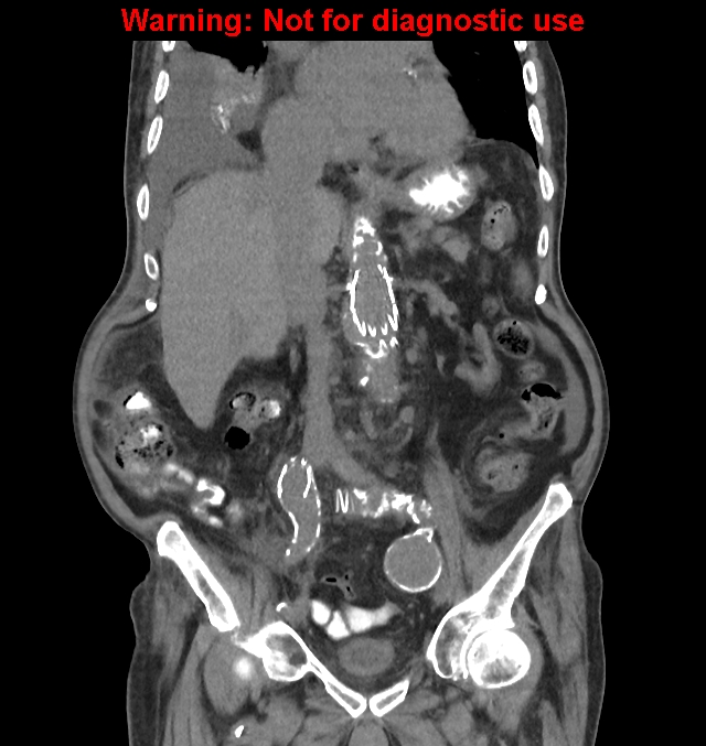 Aortic graft infection (Radiopaedia 44979-48907 non-contrast 26).jpg