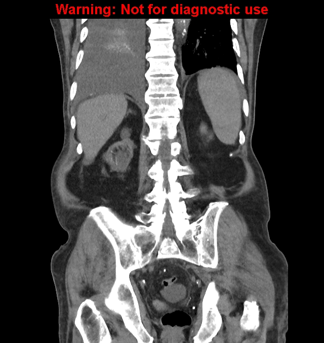 Aortic graft infection (Radiopaedia 44979-48907 non-contrast 38).jpg