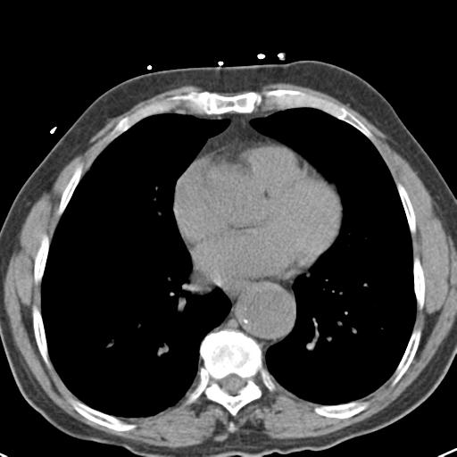 Aortic intramural hematoma (Radiopaedia 31139-31838 Axial non-contrast 35).jpg