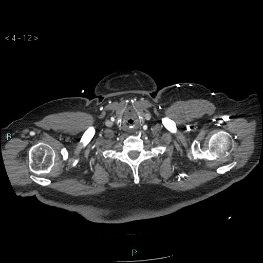 File:Aortic intramural hematoma (Radiopaedia 48463-53380 B 6).jpg