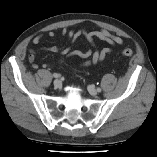 Aortic intramural hematoma (type B) (Radiopaedia 79323-92387 Axial C+ delayed 95).jpg