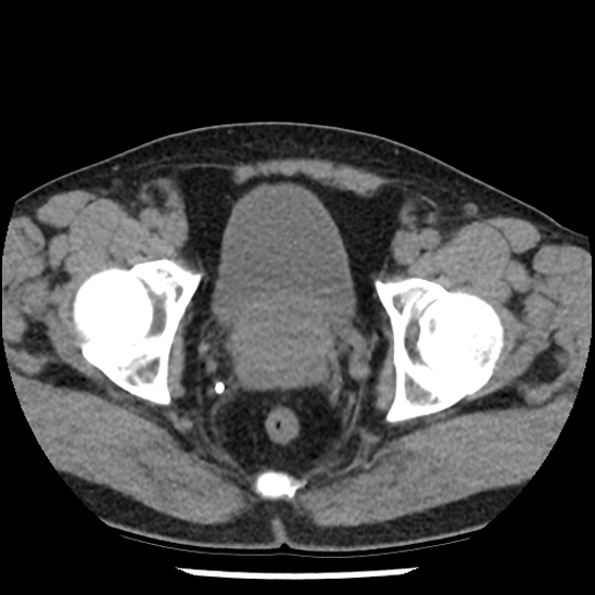 Aortic intramural hematoma (type B) (Radiopaedia 79323-92387 Axial non-contrast 109).jpg