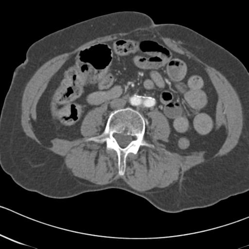 Aortic intramural hematoma from penetrating atherosclerotic ulcer (Radiopaedia 31137-31836 A 120).jpg