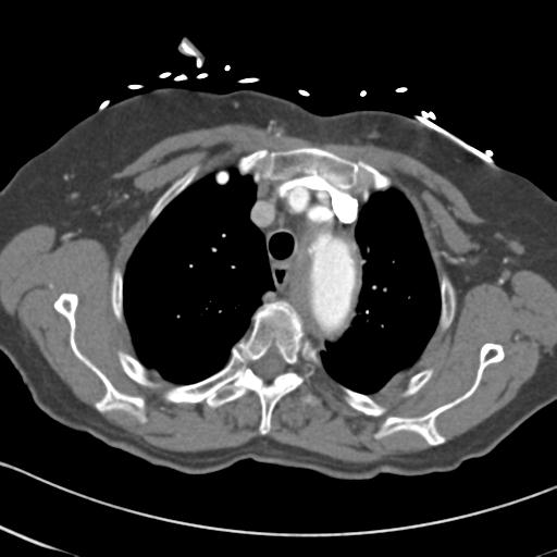 Aortic intramural hematoma from penetrating atherosclerotic ulcer (Radiopaedia 31137-31836 A 17).jpg