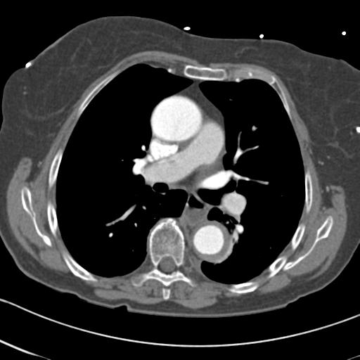 File:Aortic intramural hematoma from penetrating atherosclerotic ulcer (Radiopaedia 31137-31836 A 37).jpg