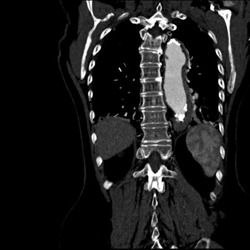 File:Aortic intramural hematoma from penetrating atherosclerotic ulcer (Radiopaedia 31137-31836 C 52).jpg