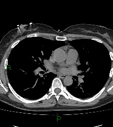 Aortic valve endocarditis (Radiopaedia 87209-103485 Axial non-contrast 52).jpg