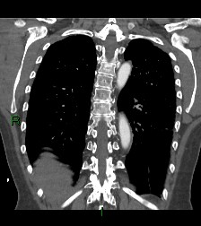 Aortic valve endocarditis (Radiopaedia 87209-103485 D 18).jpg