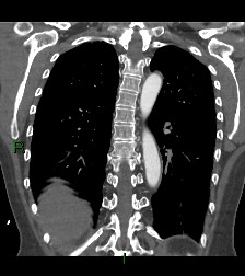 File:Aortic valve endocarditis (Radiopaedia 87209-103485 D 19).jpg