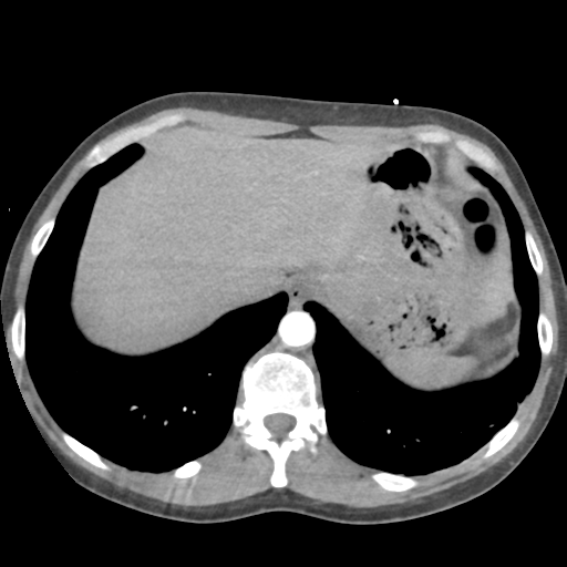 Aortic valve non-coronary cusp thrombus (Radiopaedia 55661-62189 B 44).png