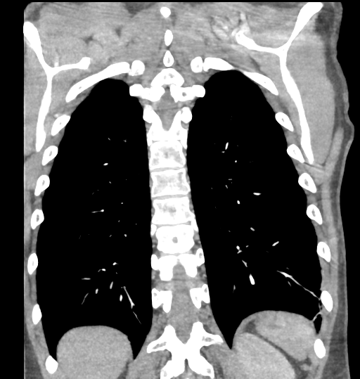 File:Aortic valve non-coronary cusp thrombus (Radiopaedia 55661-62189 C 63).png