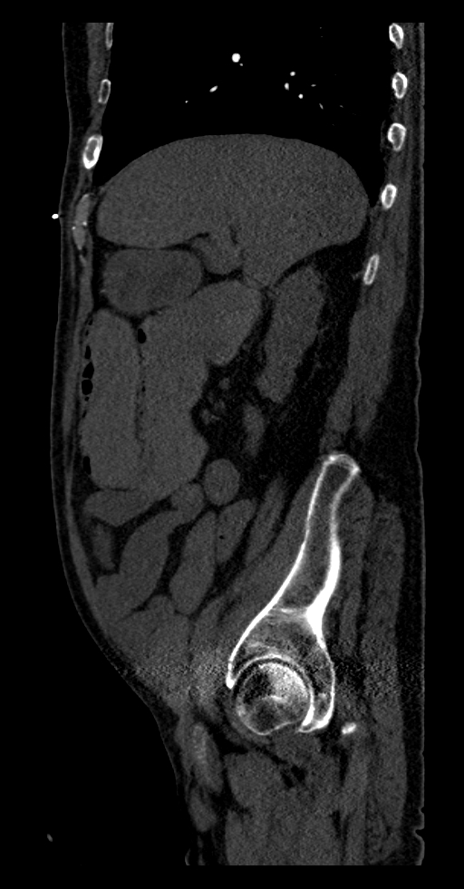 Aortoduodenal fistula (Radiopaedia 75286-86415 F 53).jpg