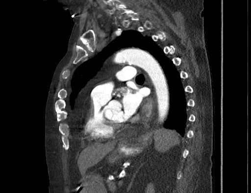 Aortoesophageal fistula with endovascular repair (Radiopaedia 73781-84592 Sagittal C+ CTPA 120).jpg
