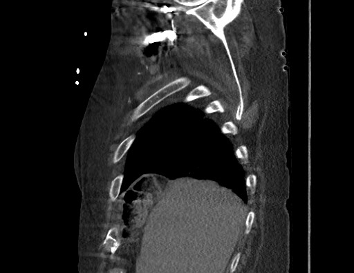 File:Aortoesophageal fistula with endovascular repair (Radiopaedia 73781-84592 Sagittal C+ CTPA 20).jpg