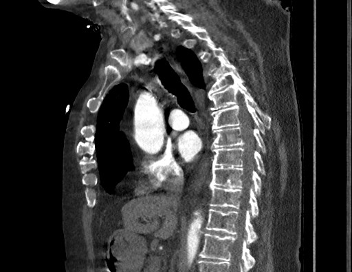Aortoesophageal fistula with endovascular repair (Radiopaedia 73781-84592 Sagittal C+ CTPA 92).jpg