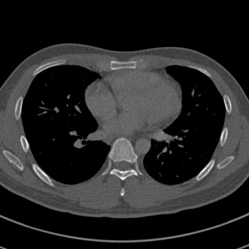 File:Apical lung mass mimic - neurogenic tumor (Radiopaedia 59918-67521 Axial bone window 48).jpg