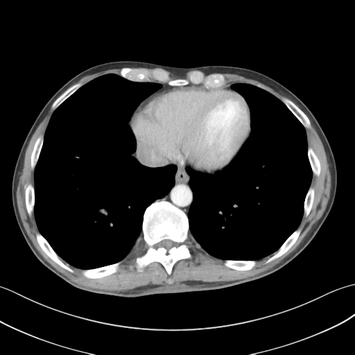 Apical pleural calcification (Radiopaedia 46141-50499 Axial C+ delayed 52).png