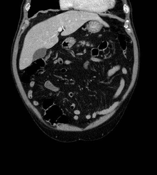 Appendiceal adenocarcinoma complicated by retroperitoneal abscess (Radiopaedia 58007-65039 A 24).jpg