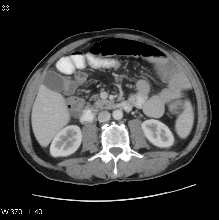 Appendicitis (Radiopaedia 27446-27642 A 14).jpg