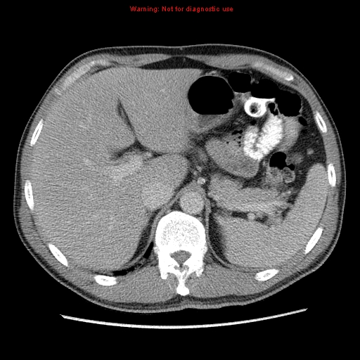 Appendicitis and renal cell carcinoma (Radiopaedia 17063-16760 A 12).jpg