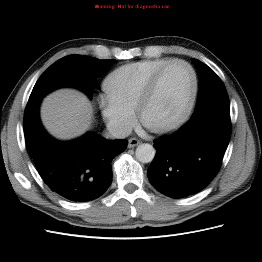 Appendicitis and renal cell carcinoma (Radiopaedia 17063-16760 A 2).jpg