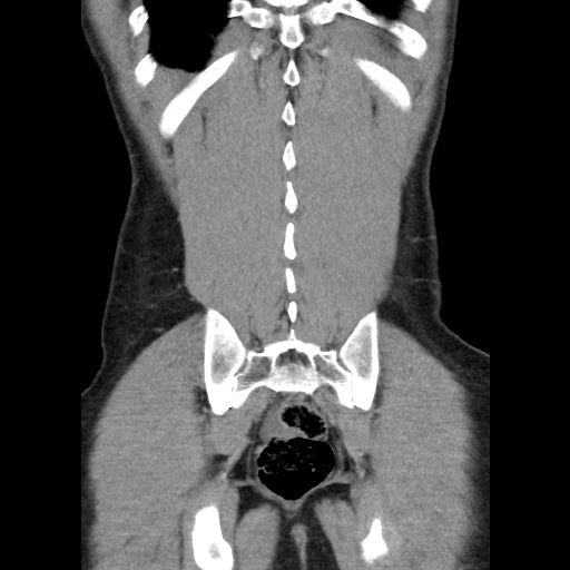 Appendicitis complicated by post-operative collection (Radiopaedia 35595-37113 B 46).jpg