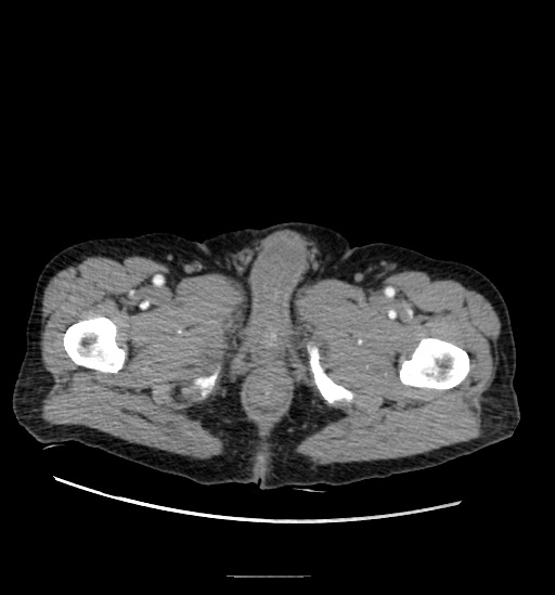 File:Appendicitis with localized perforation and abscess formation (Radiopaedia 49035-54130 A 94).jpg