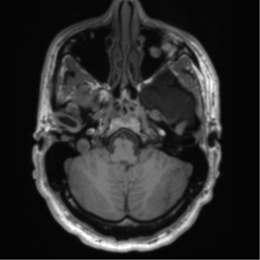 File:Arachnoid cyst with subdural hematoma (Radiopaedia 85892-101743 Axial T1 21).png