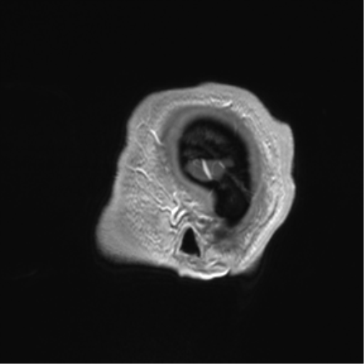 Arachnoid cyst with subdural hematoma (Radiopaedia 85892-101743 Sagittal T1 C+ 87).png