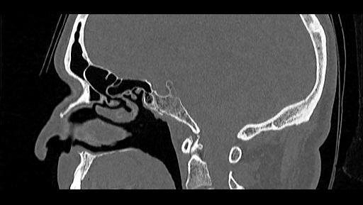 Arcuate foramen (Radiopaedia 89833-106944 Sagittal bone window 67).jpg