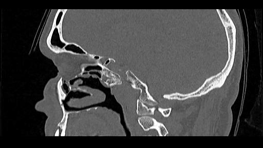 Arcuate foramen (Radiopaedia 89833-106944 Sagittal bone window 81).jpg