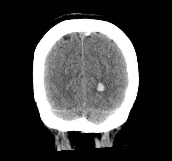 File:Arteriovenous malformation (cerebral) (Radiopaedia 40070-42579 Coronal non-contrast 33).png