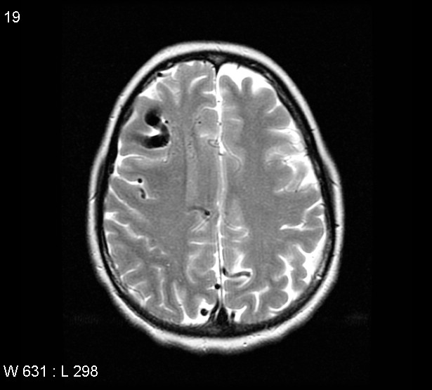 File:Arteriovenous malformation - cerebral (Radiopaedia 4000-6538 Axial T2 13).jpg