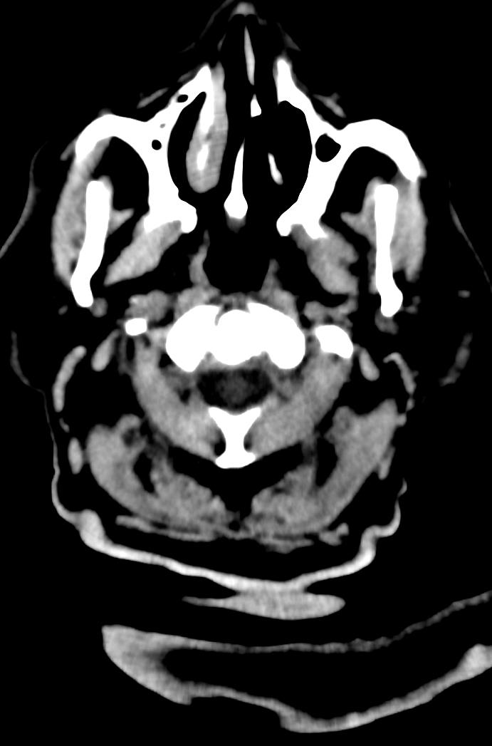 Artery of Percheron infarction (Radiopaedia 80613-94202 Axial non-contrast 2).jpg