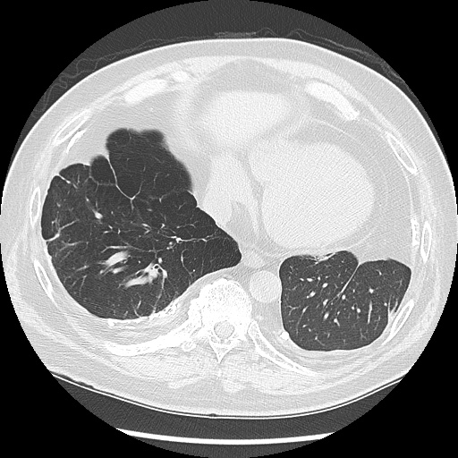 Asbestos-related pleural disease (Radiopaedia 74366-85250 Axial lung window 86).jpg