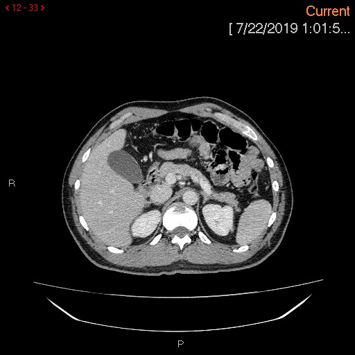 File:Ascending colonic diverticulum mimicking acute appendicitis (Radiopaedia 69943-80198 A 33).jpg