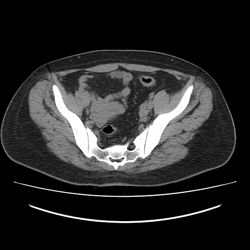 Ascending retrocecal appendicitis with liver abscesses (Radiopaedia 60066-67615 Axial non-contrast 70).jpg